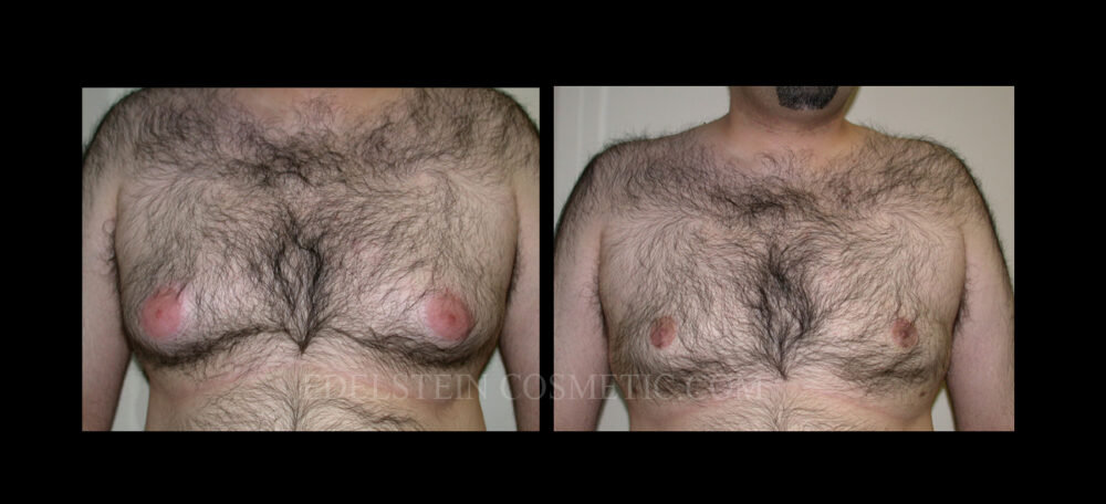 Gynecomastia case #26406