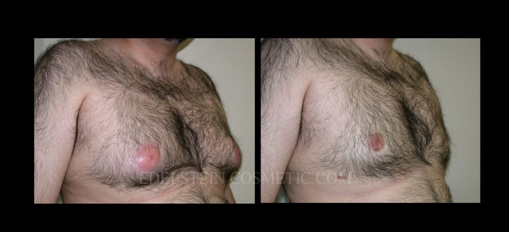 Gynecomastia case #26406