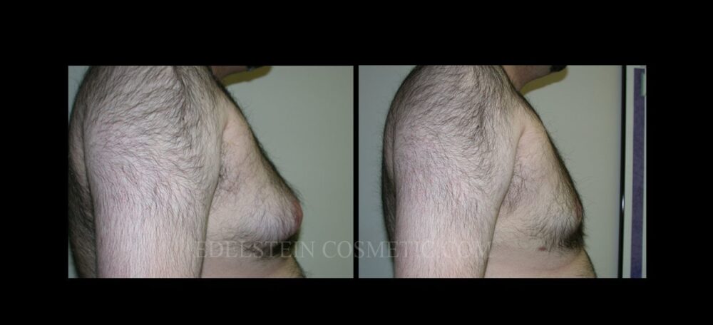 Gynecomastia case #26406