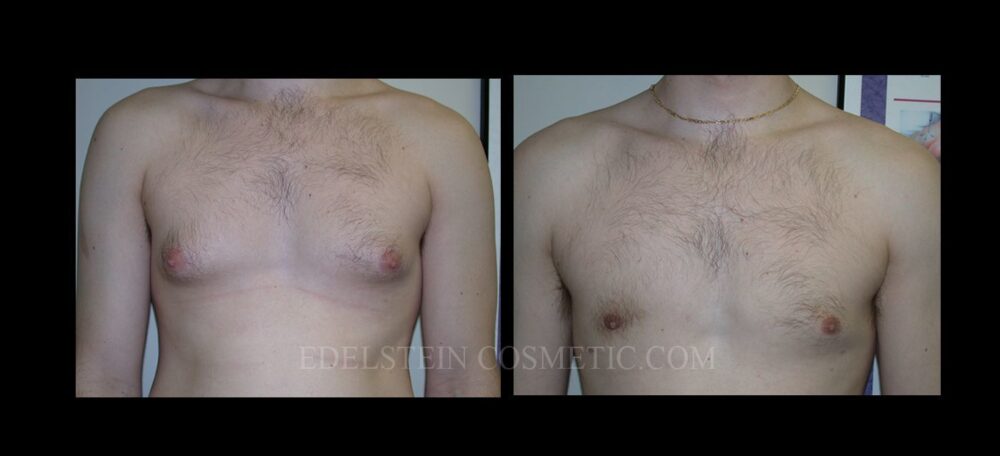 Gynecomastia case #26408