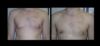 Gynecomastia case #26408 slider thumbnail