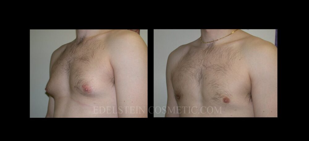 Gynecomastia case #26408