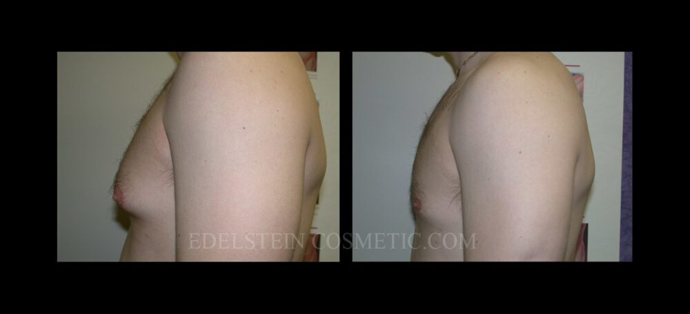 Gynecomastia case #26408