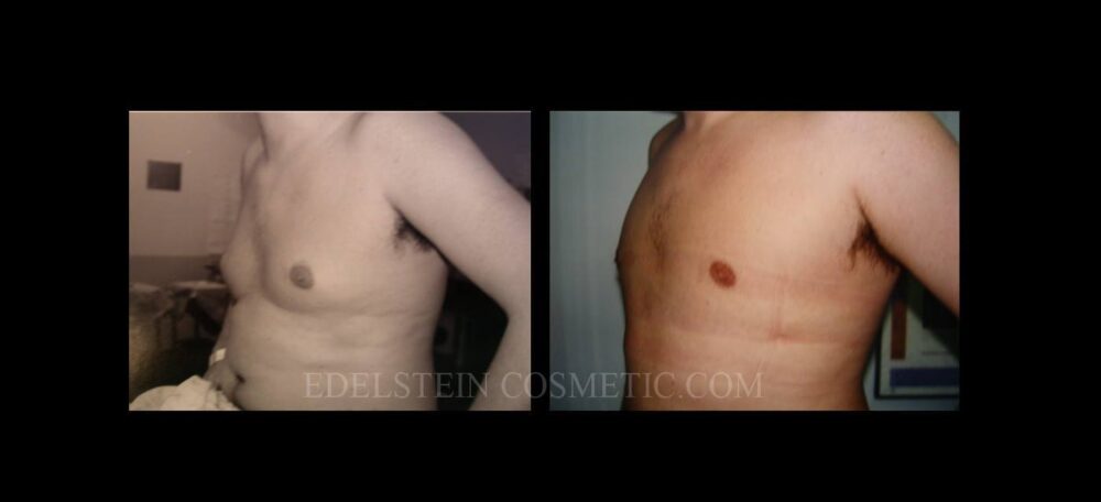 Gynecomastia case #26409