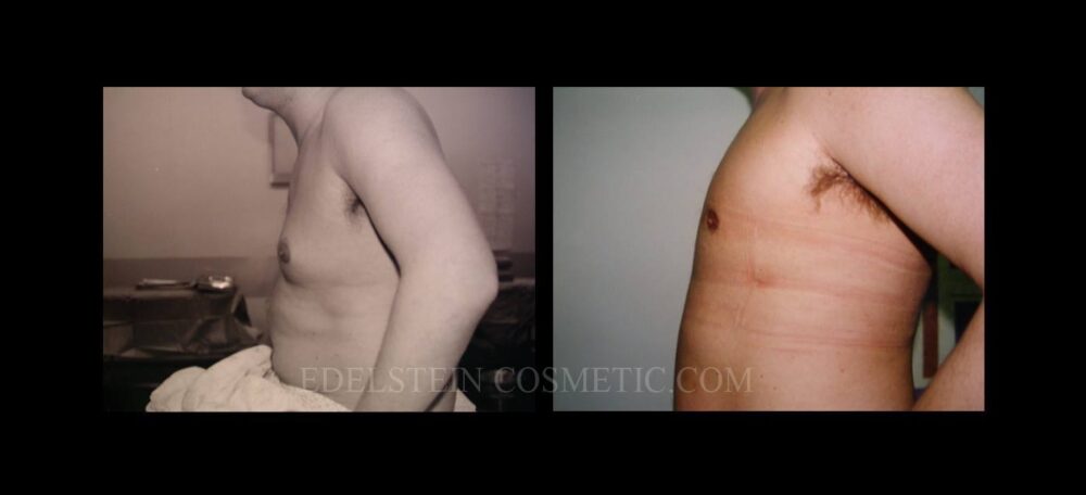 Gynecomastia case #26409