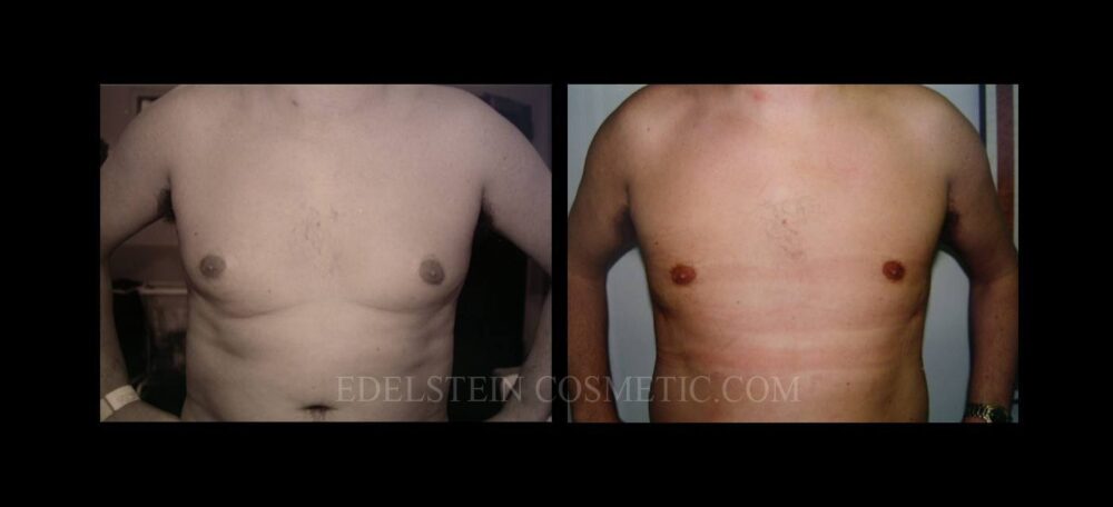 Gynecomastia case #26409