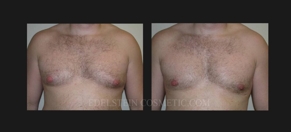 Gynecomastia case #26410