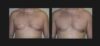 Gynecomastia case #26410 slider thumbnail