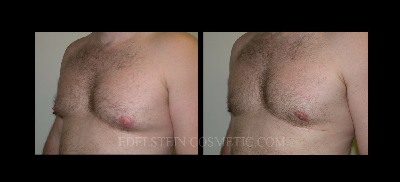 Gynecomastia case #26410