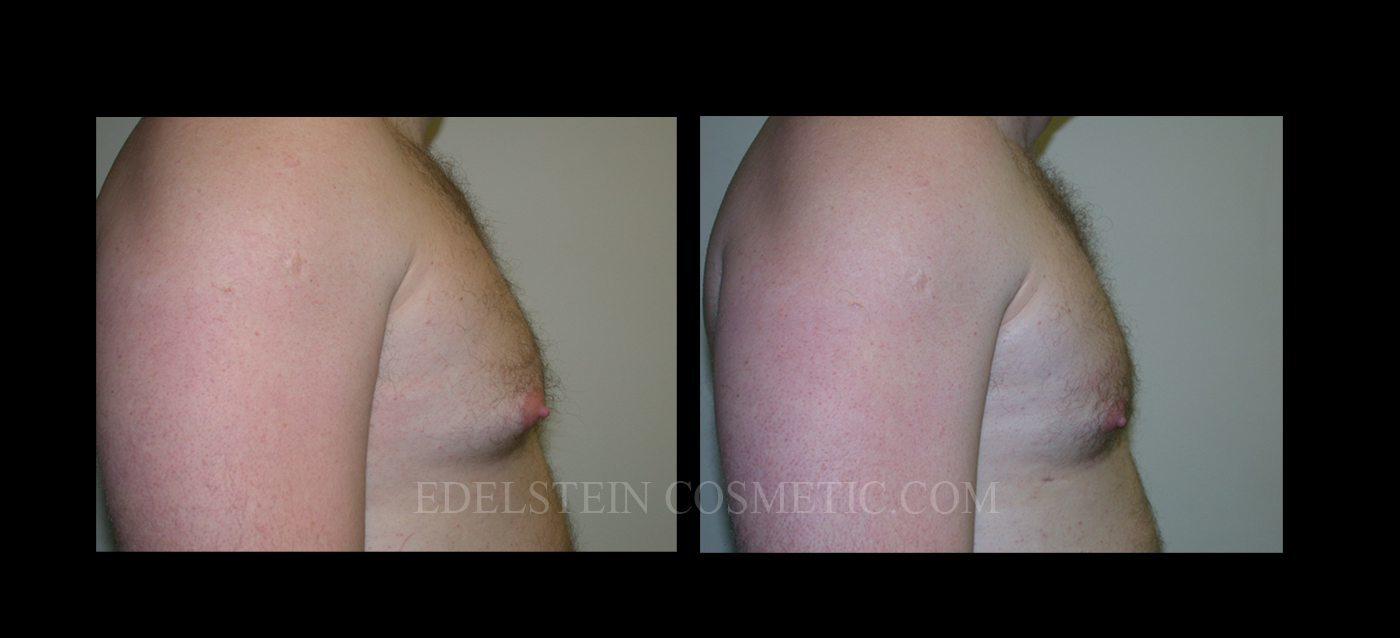 Gynecomastia case #26410