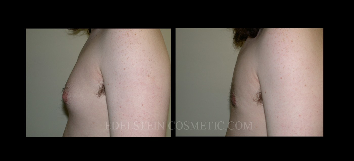 Gynecomastia case #26411