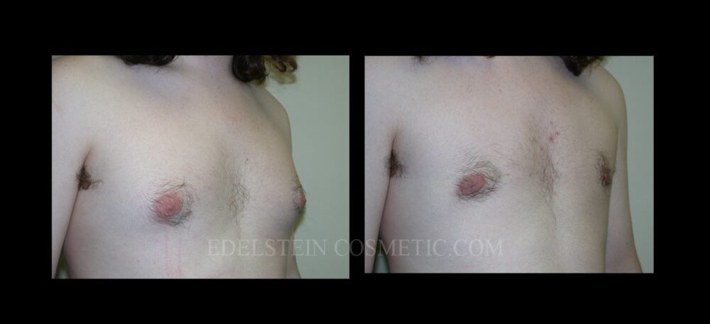 Gynecomastia case #26411