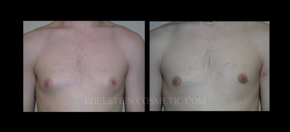 Gynecomastia case #26412