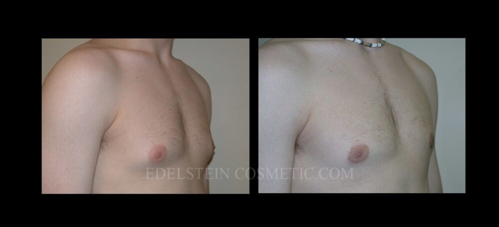 Gynecomastia case #26412