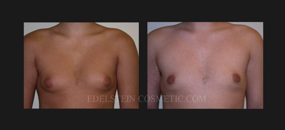 Gynecomastia case #26413