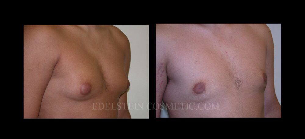 Gynecomastia case #26413