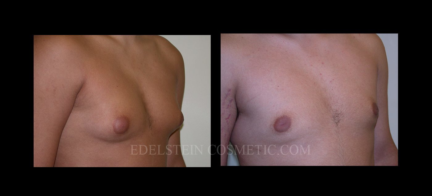 Gynecomastia case #26413