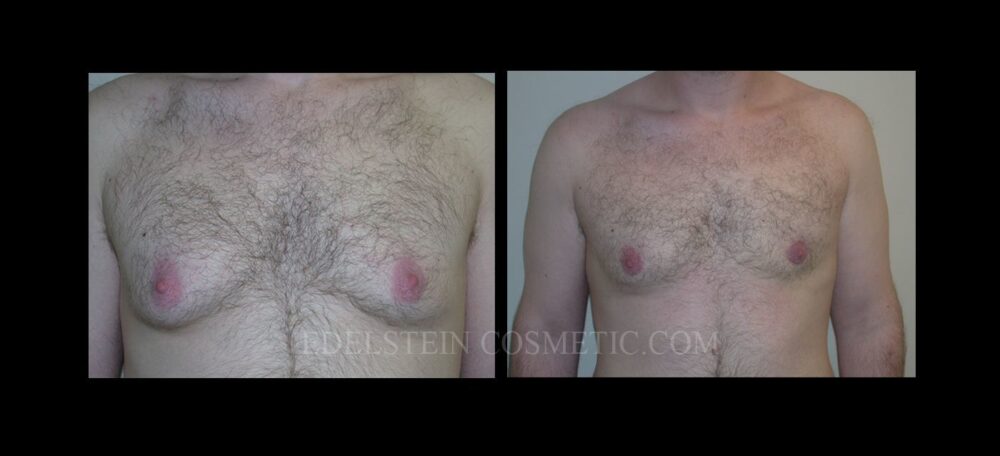 Gynecomastia case #26414