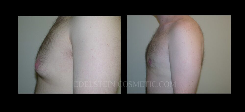 Gynecomastia case #26414