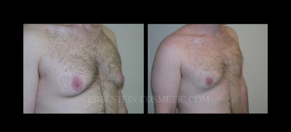 Gynecomastia case #26414