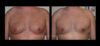 Gynecomastia case #26415 slider thumbnail