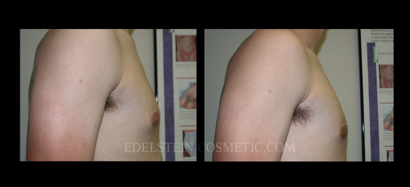 Gynecomastia case #26416