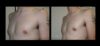 Gynecomastia case #26416 slider thumbnail