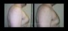 Gynecomastia case #26417 slider thumbnail