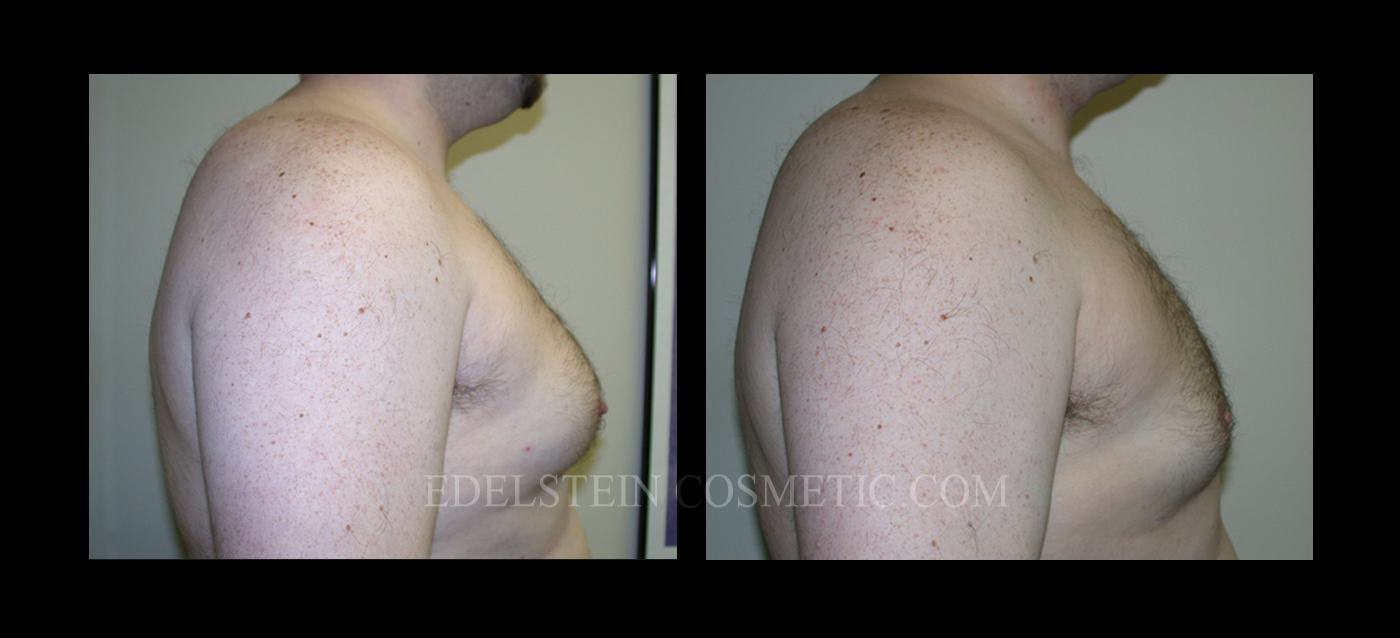 Gynecomastia case #26417