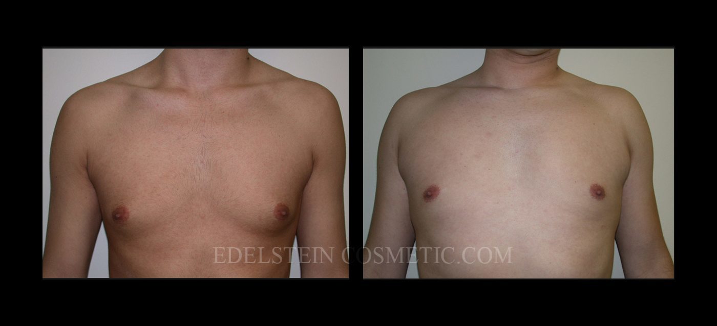 Gynecomastia case #26419