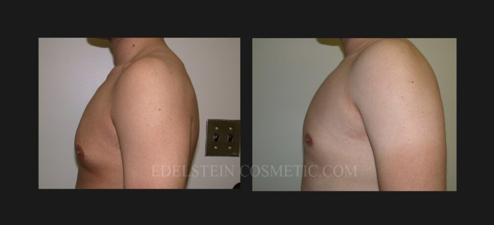 Gynecomastia case #26419