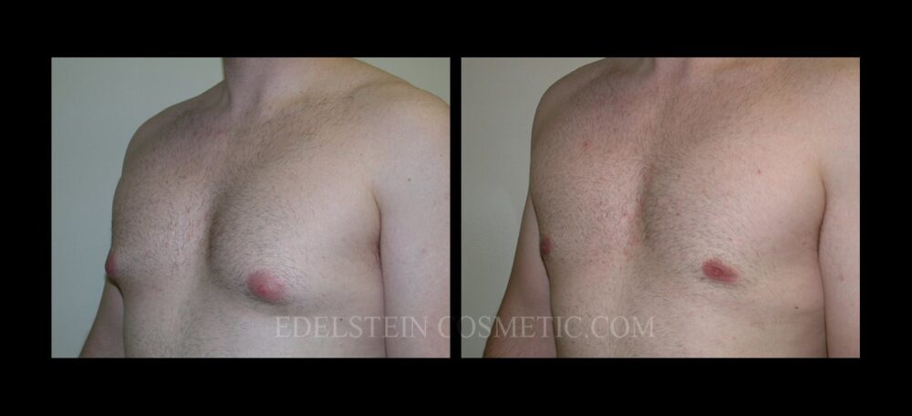 Gynecomastia case #26420