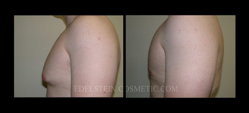 Gynecomastia case #26420