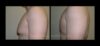 Gynecomastia case #26420 slider thumbnail