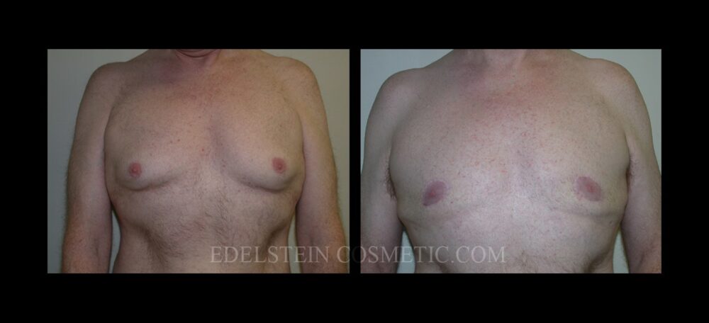 Gynecomastia case #26421