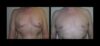 Gynecomastia case #26421 slider thumbnail