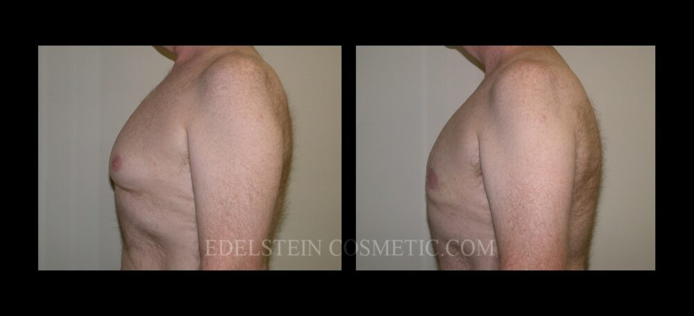 Gynecomastia case #26421