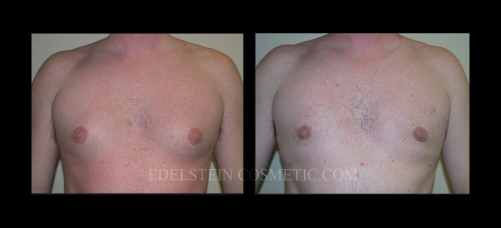 Gynecomastia case #26423