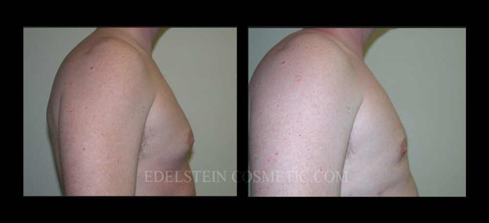 Gynecomastia case #26423