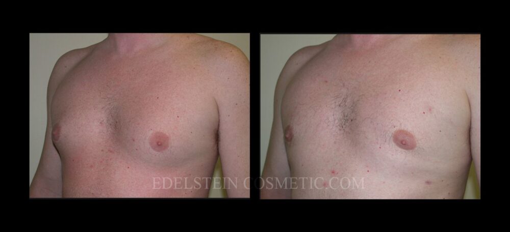 Gynecomastia case #26423