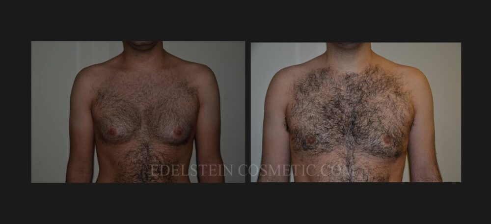 Gynecomastia case #26424