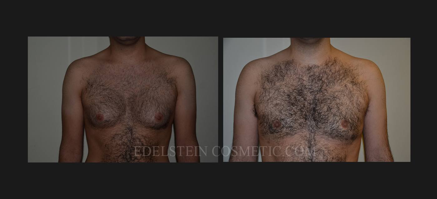 gynecomastia-before-after-p191