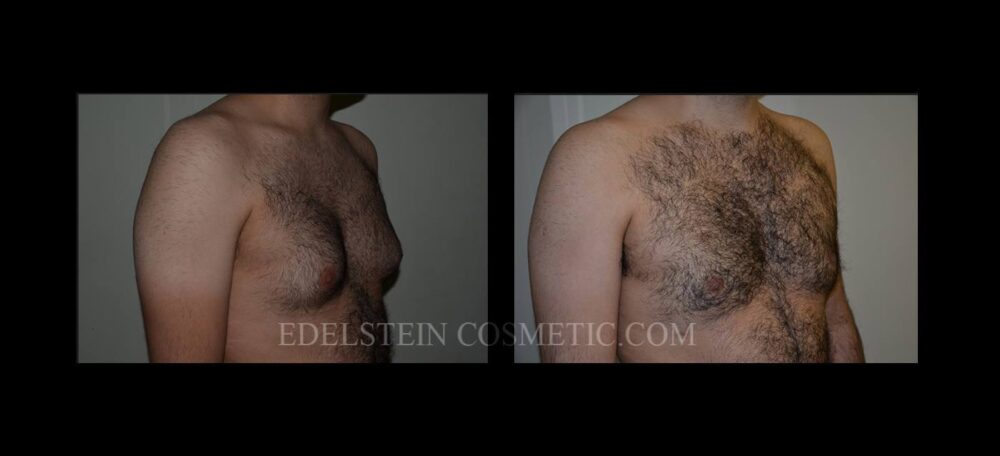 Gynecomastia case #26424