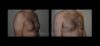 Gynecomastia case #26424 slider thumbnail