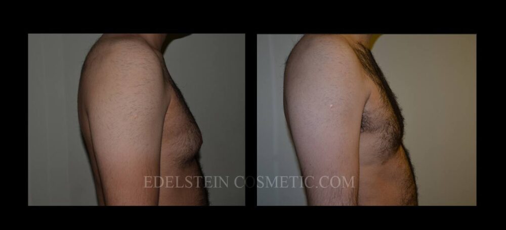 Gynecomastia case #26424