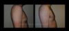 Gynecomastia case #26424 slider thumbnail