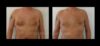 Gynecomastia case #26425 slider thumbnail