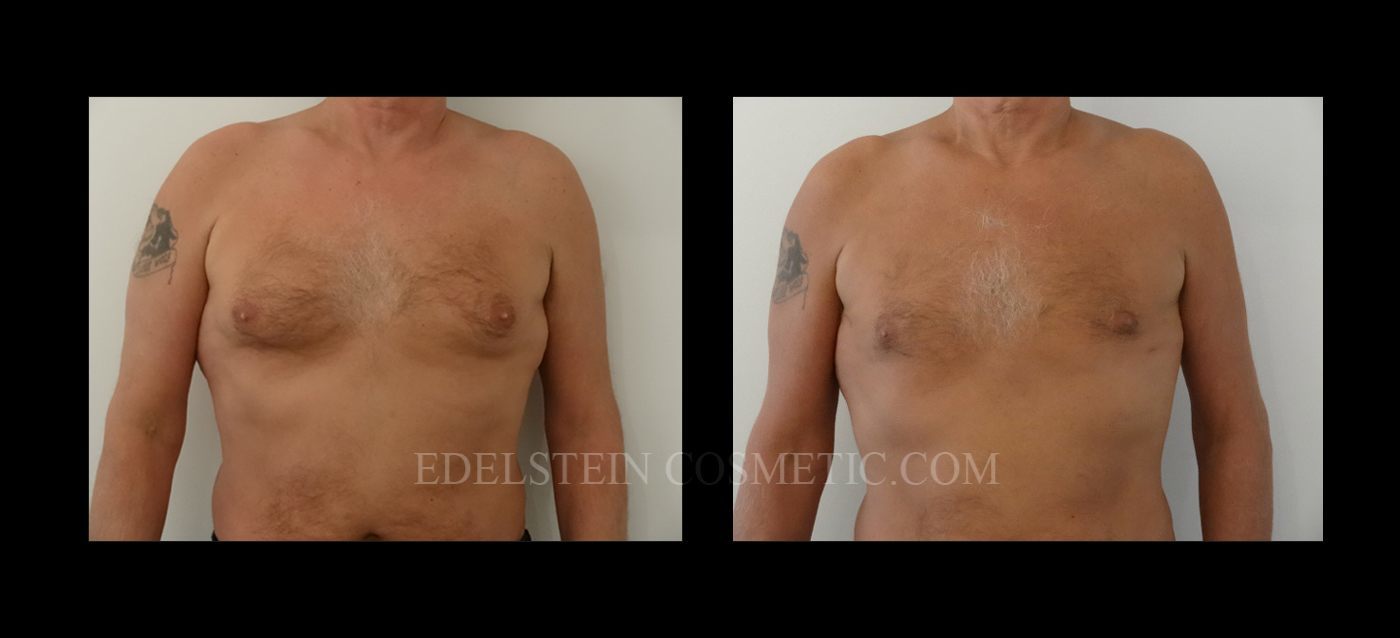 gynecomastia-before-after-p20