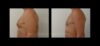 Gynecomastia case #26425 slider thumbnail