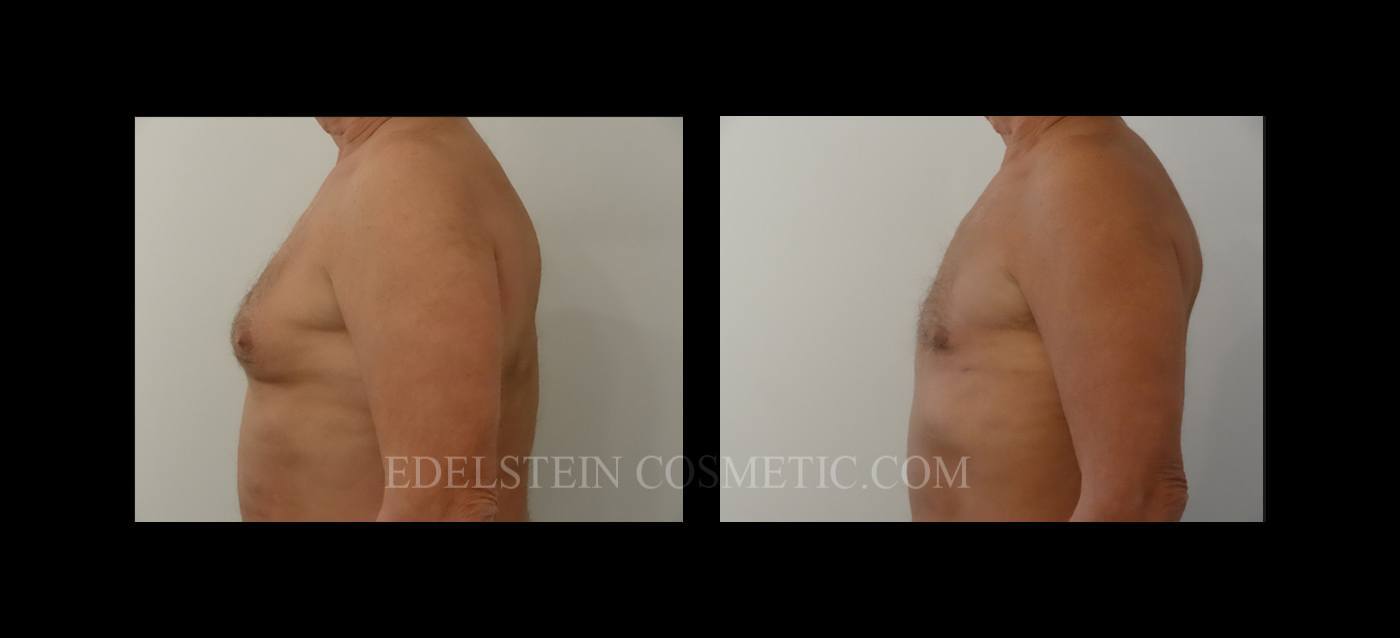 gynecomastia-before-after-p20a